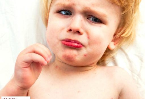 Одесса: без прививок от кори детей не примут в школы и сады «фото»