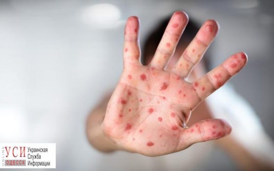 В Одессе от кори умерли 5 человек, а число заболевших перевалило за тысячу «фото»