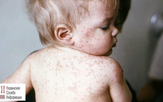 Вспышка смертельной болезни в Одессе: когда удастся победить корь «фото»