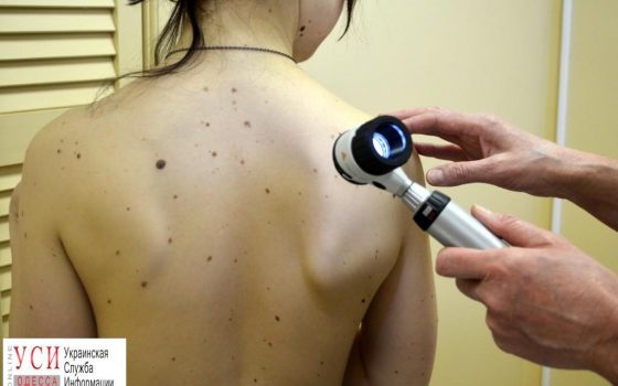 В День диагностики меланомы, одесситы смогут проверить родинки «фото»