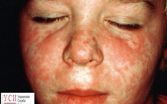 В Одессе за неделю 20 человек заболело корью «фото»