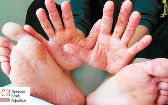 Корь не покидает Одессу: за прошлую неделю заболело еще 70 человек «фото»