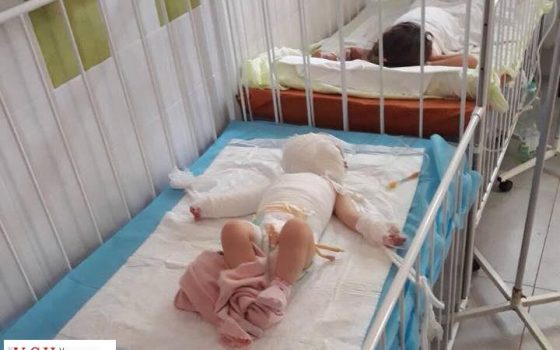 В Одессе маленькая девочка получила ожог 20% тела из-за чайника с кипятком «фото»