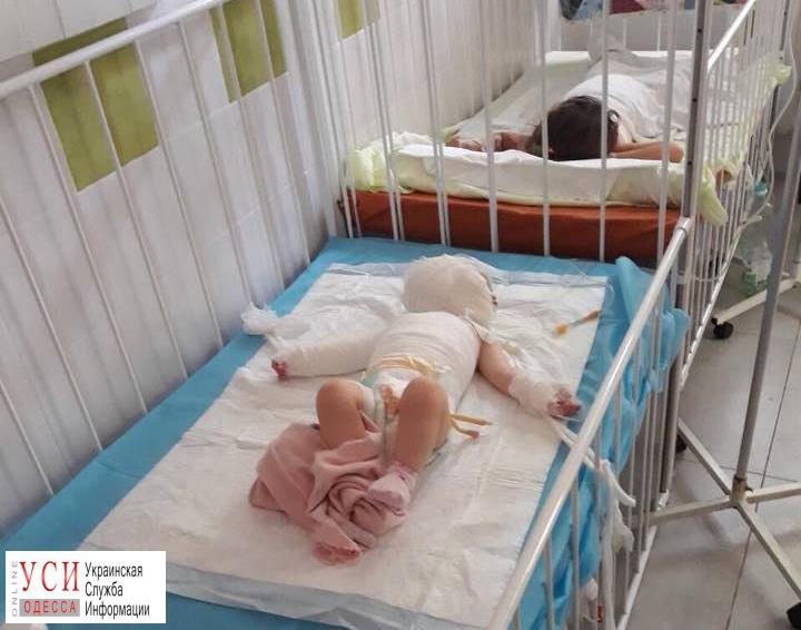 В Одессе маленькая девочка получила ожог 20% тела из-за чайника с кипятком «фото»