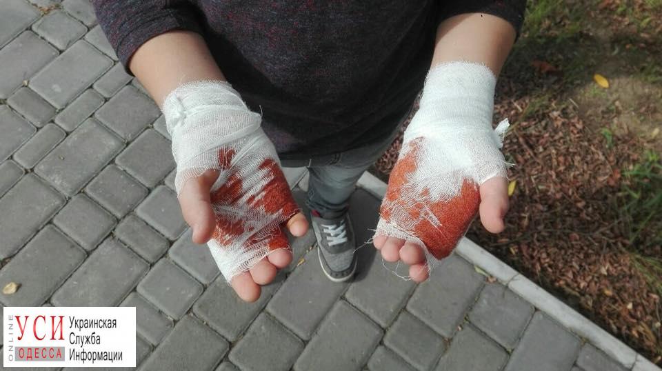 Опасный праздник: одесский школьник получил химический ожог рук во время детского шоу (фото) ОБНОВЛЕНО «фото»