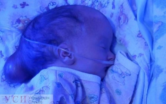 Одесситов просят помочь младенцу с гидрофцефалией: двухнедельная Ева нуждается в шунтировании «фото»