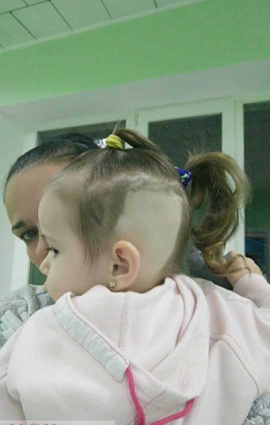 Двухлетней Эле, на операцию которой собрали 750 тысяч гривен, поставили имплант «фото»