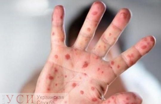 Число детей, заболевших корью в Килийском районе, возросло до 40 – медики винят родителей «фото»