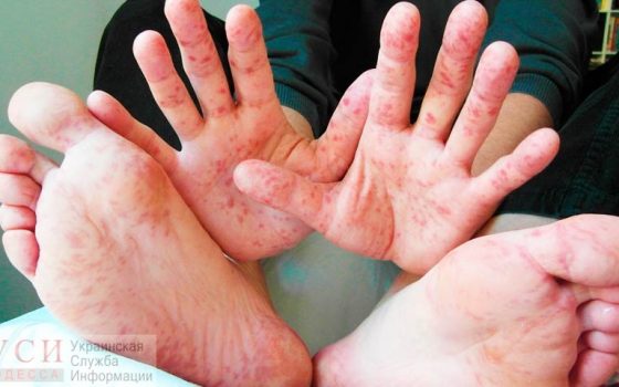 Корь наступает: в одном из сел области с понедельника вводят карантин «фото»