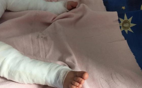 Одесситов просят помочь: 11-месячный ребенок упал в кипяток и получил 80% ожогов тела (фото, видео) usionline.com Одесситов просят помочь: 11-месячный ребенок упал в кипяток и получил 80% ожогов тела (фото, видео) «фото»
