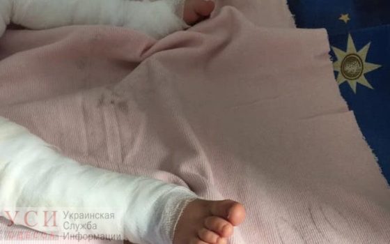 В Одессе решили не перевозить 11-месячного ребенка с ожогами в Киев, а за 2 дня собрали миллион (фото) usionline.com В Одессе решили не перевозить 11-месячного ребенка с ожогами в Киев, а за 2 дня собрали миллион (фото) «фото»