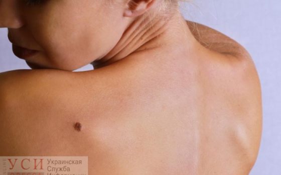 День борьбы с меланомой: в Одессе сегодня можно бесплатно пройти обследование кожи «фото»