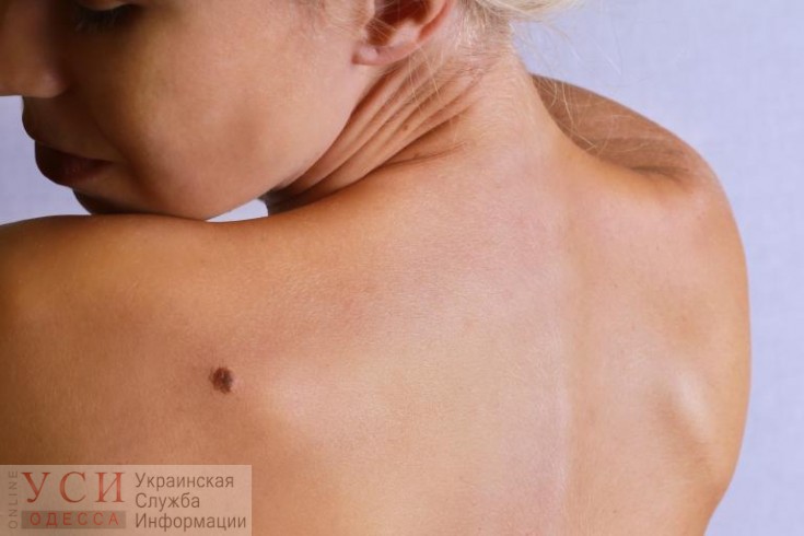 День борьбы с меланомой: в Одессе сегодня можно бесплатно пройти обследование кожи «фото»