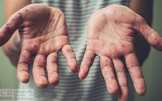 Корью заболевают более 20 одесситов в неделю «фото»