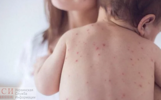 Корь – управляемая инфекция: вся правда о смертельной болезни «фото»