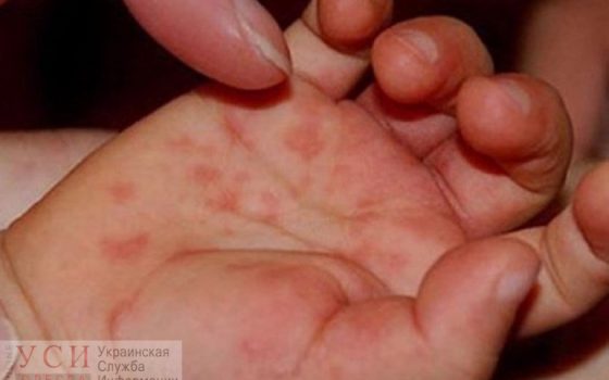В Одессе снова выросла заболеваемость корью «фото»