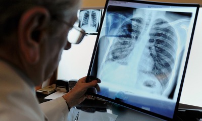 Туберкулез: как в Одесской области борются со страшным недугом «фото»