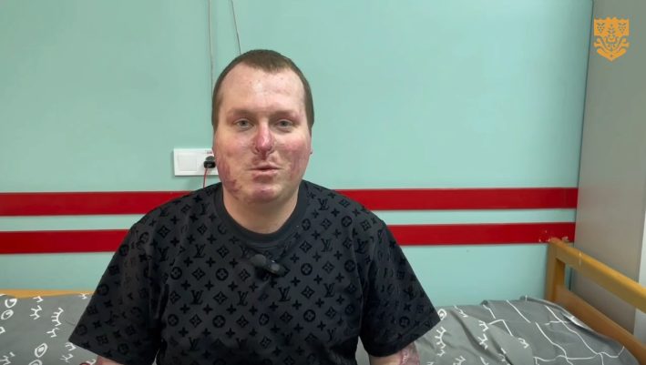 Повернення до життя: як медики Одеси врятували поліцейського з 85% опіків «живим піском» usionline.com Повернення до життя: як медики Одеси врятували поліцейського з 85% опіків «живим піском» «фото»