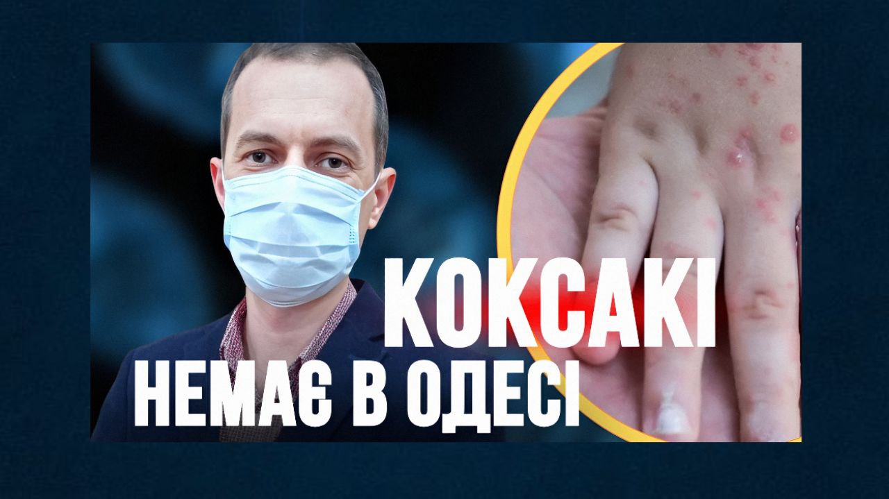 В Одесі немає спалаху вірусу Коксакі, – медики (відео) «фото»