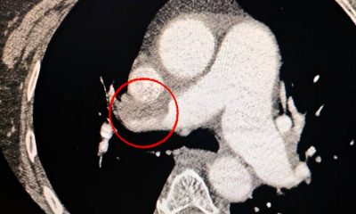 В Одеській лікарні № 10 успішно провели складну операцію (фото) «фото»