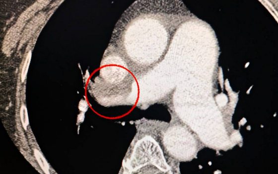 В Одеській лікарні № 10 успішно провели складну операцію (фото) «фото»