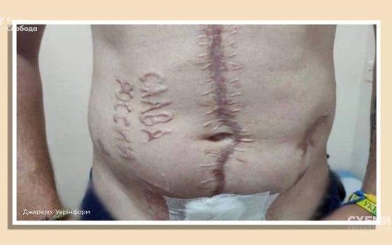 Хто випалив «Слава России» на тілі українського полоненого: журналісти встановили імена російських хірургів (фото) «фото»